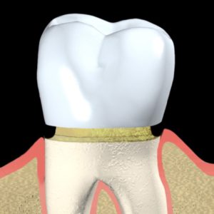 Dental Bridge