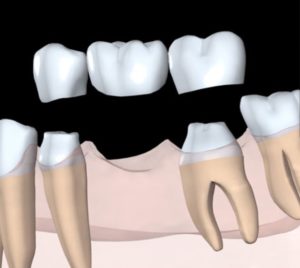 Dental Crown