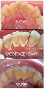 Progression of Tartar