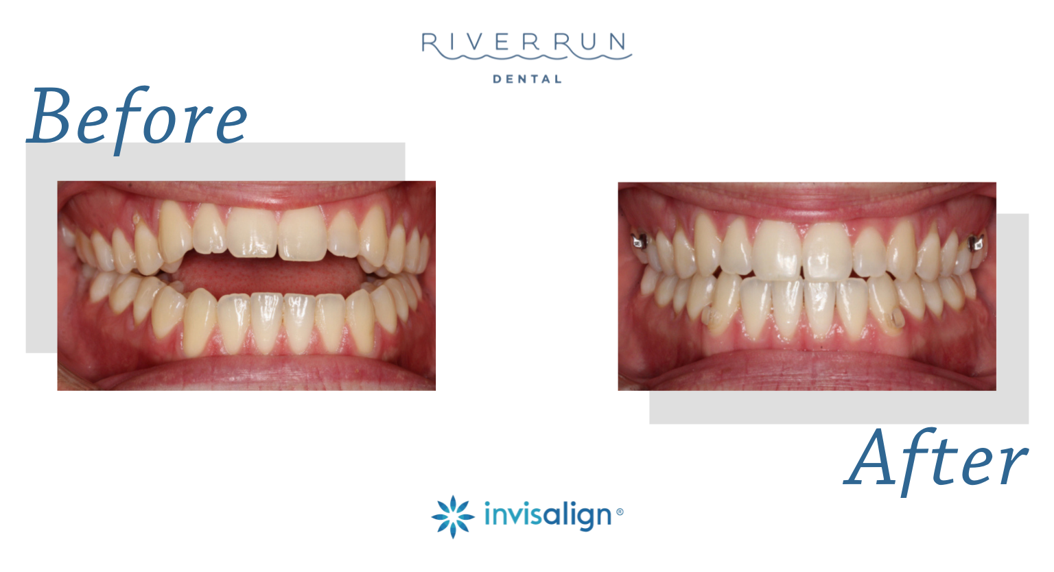 Patient before and after Invisalign treatment