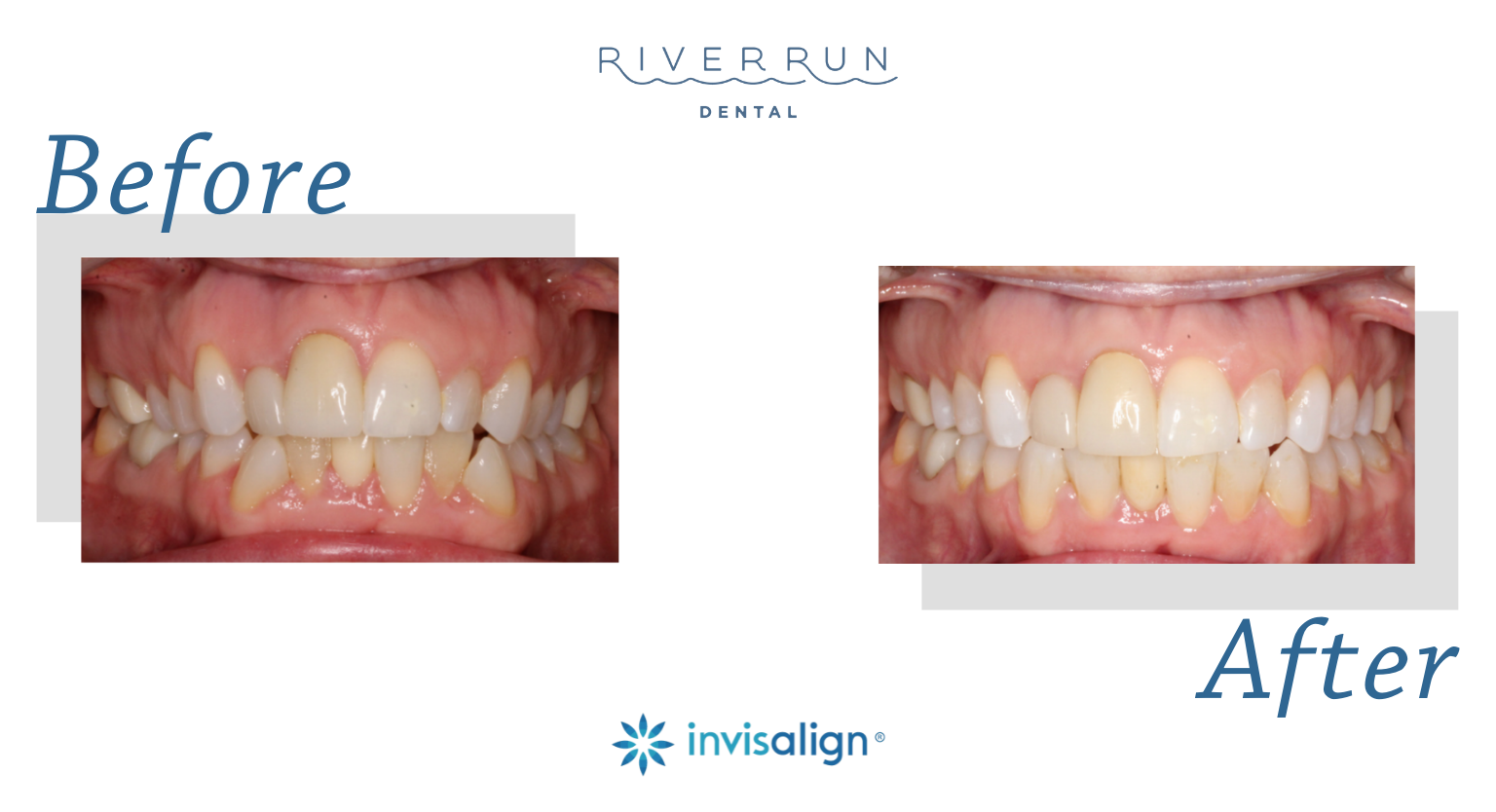Patient before and after Invisalign treatment