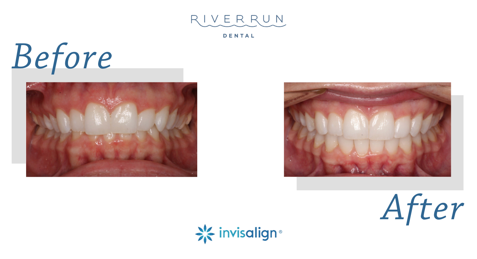 Patient before and after Invisalign treatment