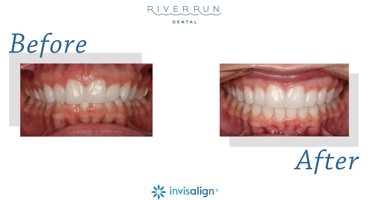 Patient before and after Invisalign treatment